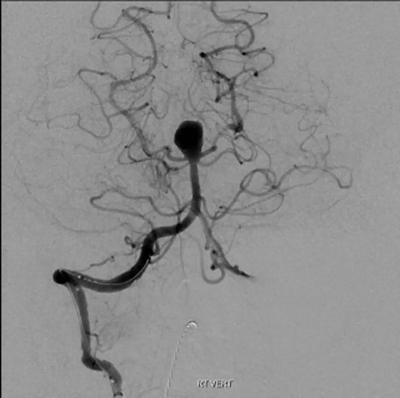 Digital Subtraction Angiography (DSA)